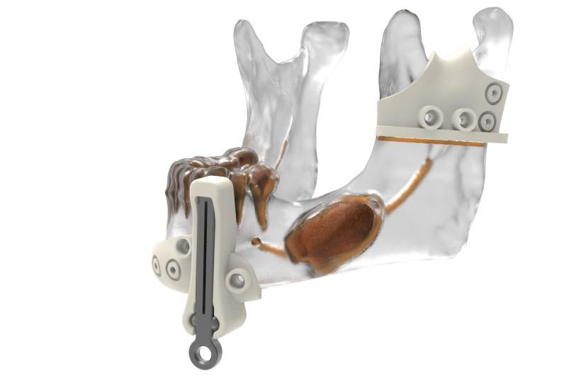 3D-printed devices improve surgical outcomes