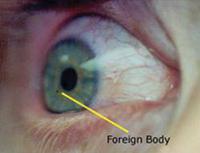 foreign body eye injury