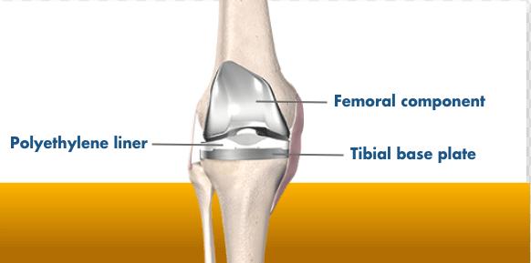 how 3D printed knee implant components fit on a patient